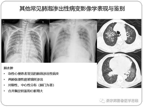 新冠状病毒肺炎影像学诊断与鉴别 心血管病医师需知