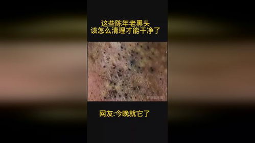 这些陈年老黑头改怎么清理才能干净了