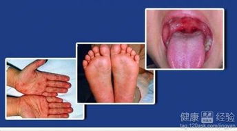手足口并发症？手足口病并发症会一直咳嗽吗 手足口病后咳嗽怎么办