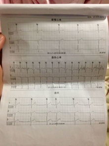 心律不齐.窦性心动过缓. 