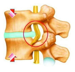 别人事业突出我腰突 科普也卖萌 了解这些腰椎间盘突出早好了