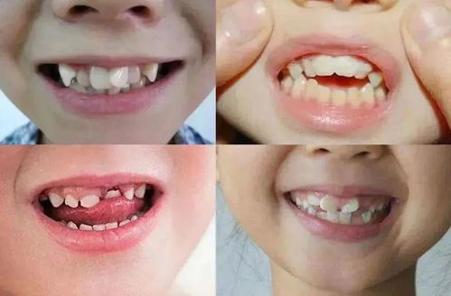 儿童牙齿不整齐需要矫正吗(儿童牙齿不整齐怎么办)