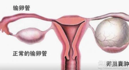 原创卵巢囊肿影响怀孕吗？