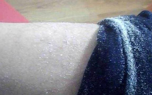 冬天冷，好几个月没洗澡了腿上和身上为什么会有那么多的白皮屑