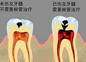 我做完根管治疗后 第二天牙齿不疼 但是脸肿 治疗前就有点肿的 治疗的那颗牙齿外面牙肉疼 脸摸着