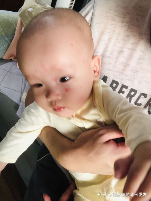 打麻腮风疫苗,送3天高烧 1次幼儿急疹 