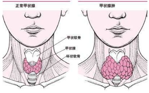 甲状腺结节,一定要做手术切除吗 会复发吗 读完此文为您解惑