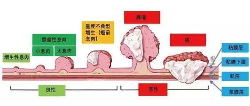 肠内癌变,大便先知 大便若有4种 异常 ,建议早做肠癌检查