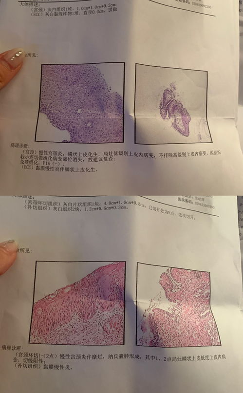 hpv16阳性 活检了结果 不排除高级病变 然后锥切结果是切缘阴性,这样是好了的意思么 