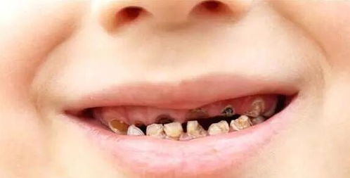 6岁孩子天天都刷牙却需要换假牙,是医生乱诊断还是父母太大意