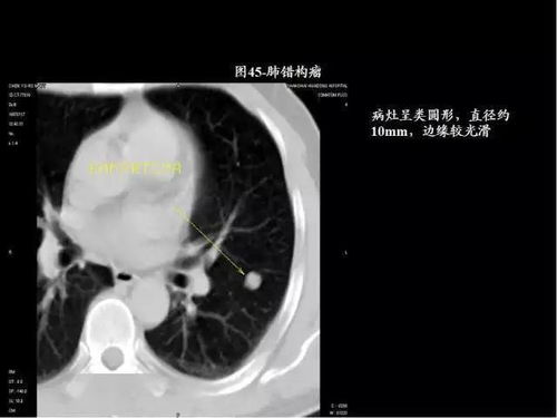 80张图,学会肺CT分段及典型疾病影像