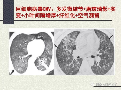 肺部感染严重可有什么办法救治