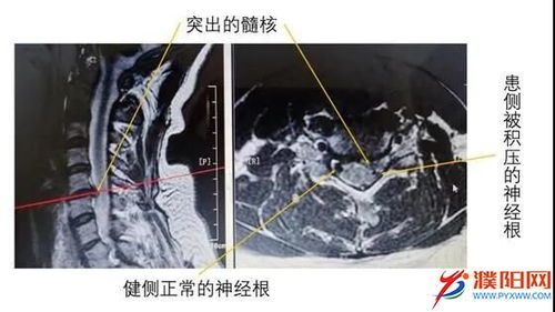 颈椎管狭窄症的手术成功率多高(颈椎管狭窄手术成功率有多大)