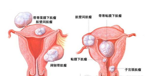 宫颈癌的症状具体都有哪些表现 