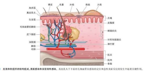 皮肤溃疡久治不愈,隐藏感染要警惕