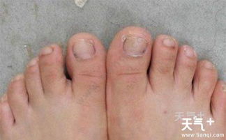 脚上的灰指甲如何根除 灰指甲的治疗方法