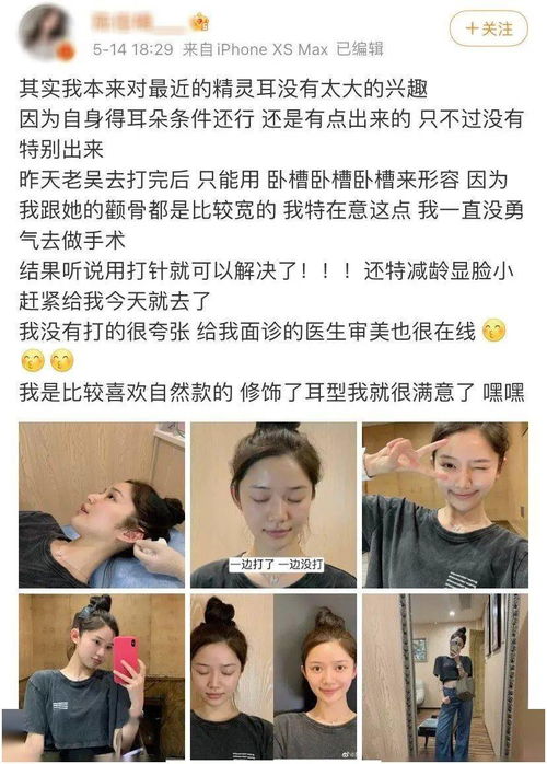 女孩长招风耳有什么象征