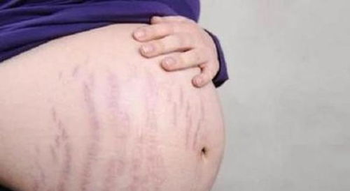 原创有四类孕妈容易长妊娠纹，如果做好这三点，可降低长妊娠纹的几率