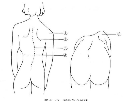 脊柱畸形别骂孩子,责任在家长 医生 看5个部位,在家就能筛查 问题 