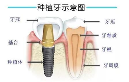 为什么一旦有牙髓炎，牙医第一建议都是钻孔杀神经戴牙冠(牙髓炎钻孔打麻药吗)