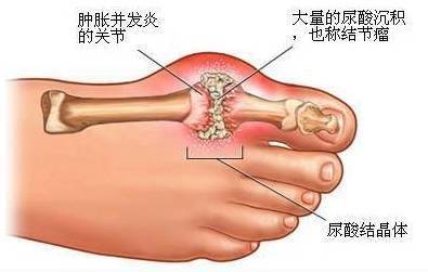 痛风就是酸毒排不出去,要根除必须调肾
