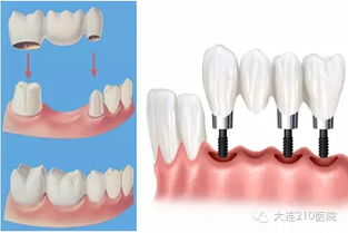 牙医为什么不建议种牙(为什么牙医都建议种牙)