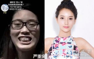 韩国 整形女 走红 龅牙女巨人整容变女神 