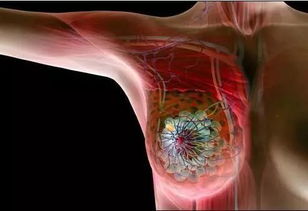 得了乳腺癌一定要切除乳房 葛新 这样的患者可以做乳腺癌保乳手术 