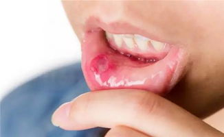 口苦咽干口腔溃疡中医辨证,治疗口腔溃疡的中医辨证方法有哪些?