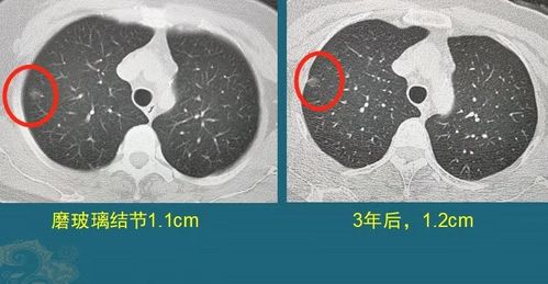 磨玻璃结节定期复查,如果是肺癌,会不会耽误治疗 医生举例细说