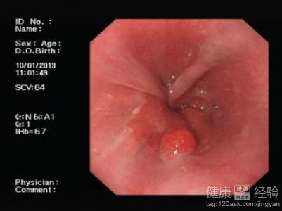 贲门息肉的临床表现 