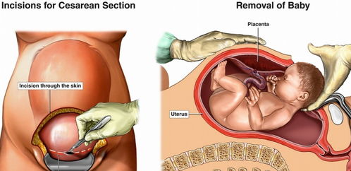 有种 遭罪 叫剖腹产,生孩子要闯8大关,才能手术顺利恢复得好