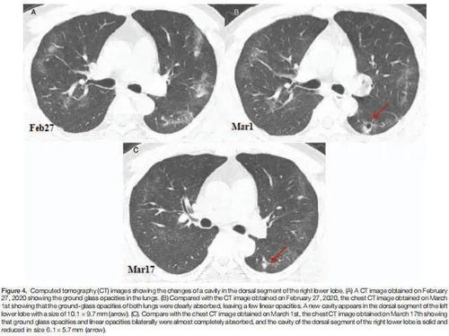 赞 孝昌陈进清医生以第一作者身份在国际医学期刊发表SCI论文