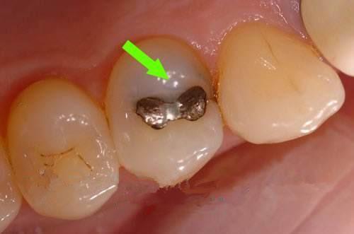 麦芽口腔知识分享 补牙之后为什么牙齿发黑了 