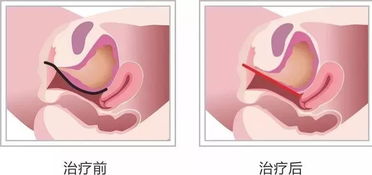 蕊丽无创激光 紧跟国际女性私密抗衰新潮流