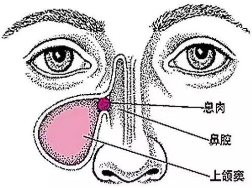 清鼻堂科普 不注重鼻息肉有什么后果