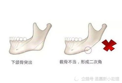 张笑天科普 下颌角长曲线截骨,你了解多少