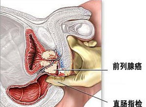 前列腺癌,前列腺癌如何治疗,前列腺癌的症状 肿瘤科 肿瘤内科 寻医问药 xywy.com 