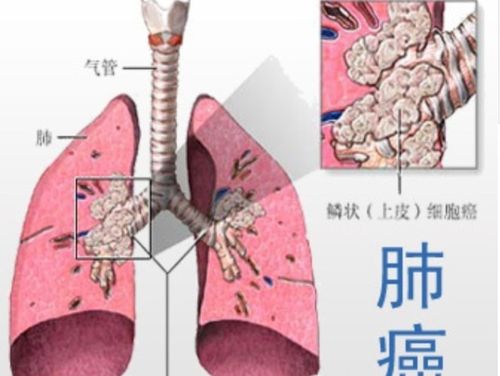 患上肺癌你到底还能活多久呢