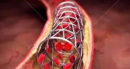 做心脏支架到底好不好 放了支架后还能活多久 看完你就明白了