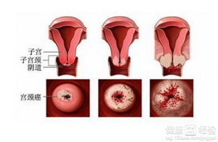 宫颈癌病人的饮食禁忌是什么(宫颈癌患者的日常饮食方法)