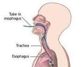 喉气管食管裂