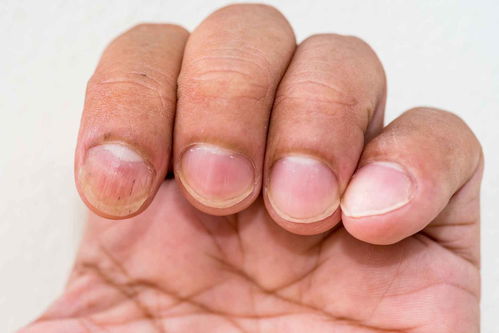 十个手指甲只有大拇指有月牙