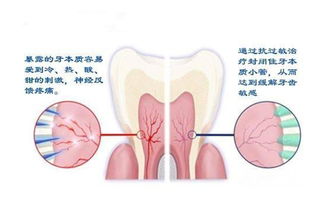 引发牙髓炎发生的四大因素
