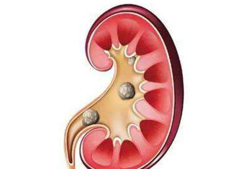 男子腰痛查出肾结石,哪些习惯易发病 预防肾结石每天喝多少水
