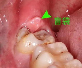 智齿牙肉肿痛图片 搜狗图片搜索