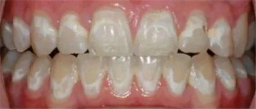 戴牙套会损伤牙齿表面吗 脱矿是怎么回事