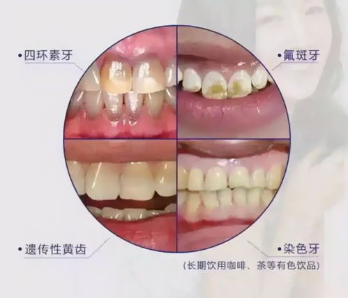 牙齿为什么会变黄 且怎么刷都刷不白