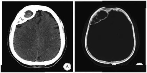 小儿硬脑膜下血肿 图片欣赏中心 急不急图文 Jpjww Com