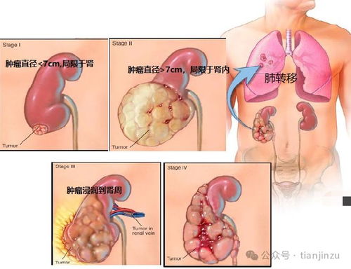 脾湿气重怎么办？这些食疗方法或许能帮到你